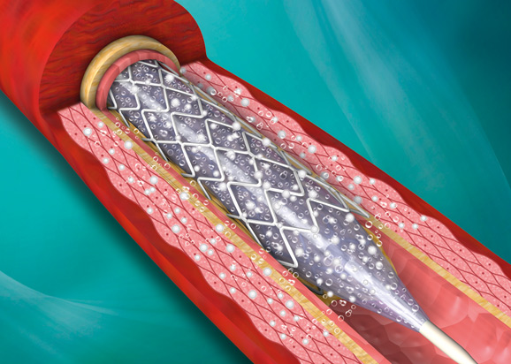 PRECISION® | Cobalt Chromium Coronary Stent System - Cardionovum®